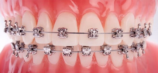 Fast Orthodontic Treatment Results Fast Orthodontic Treatment Results