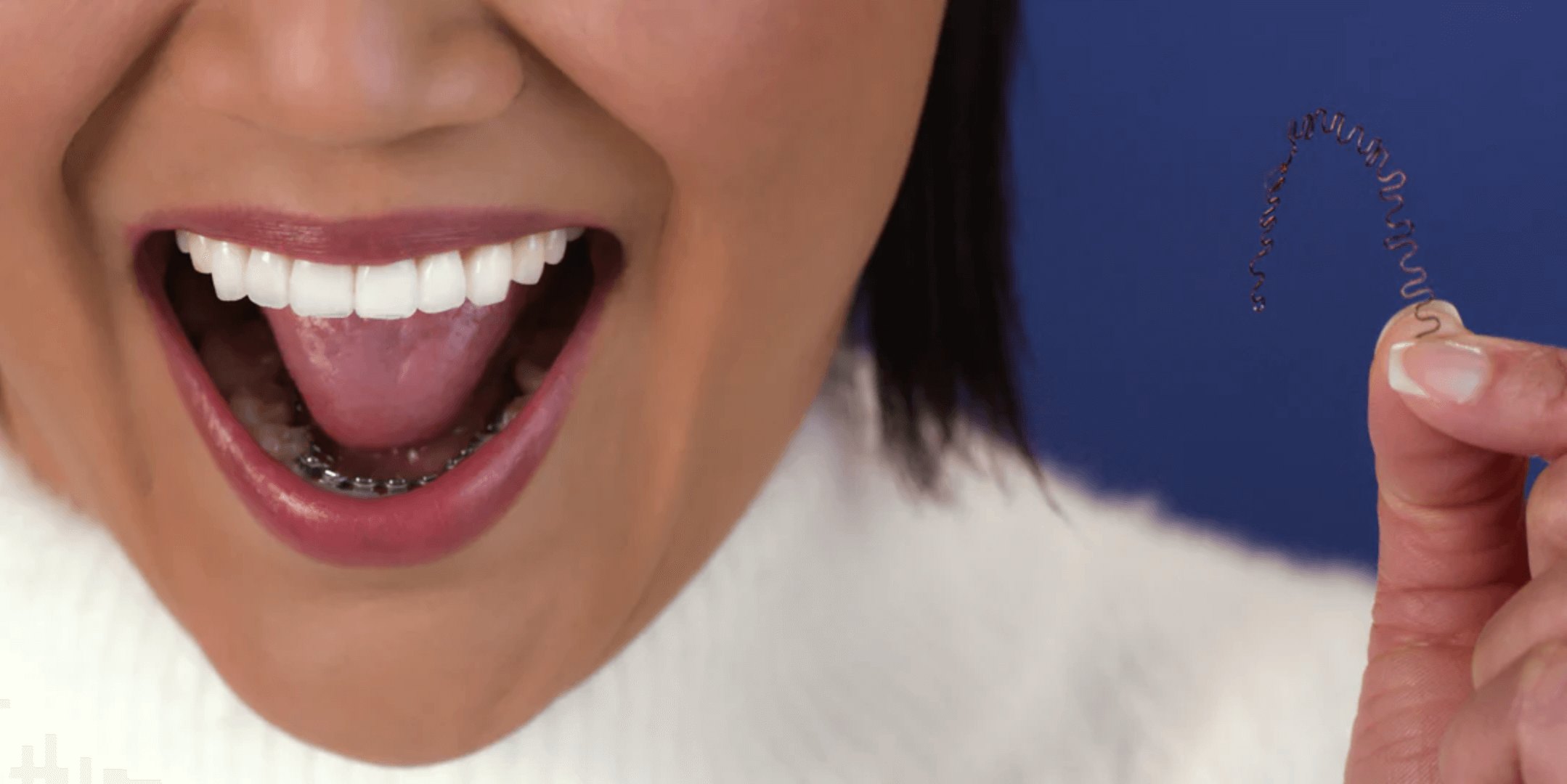 The Evolution Of Lingual Braces: Inbrace Leads The Way In Invisible ...