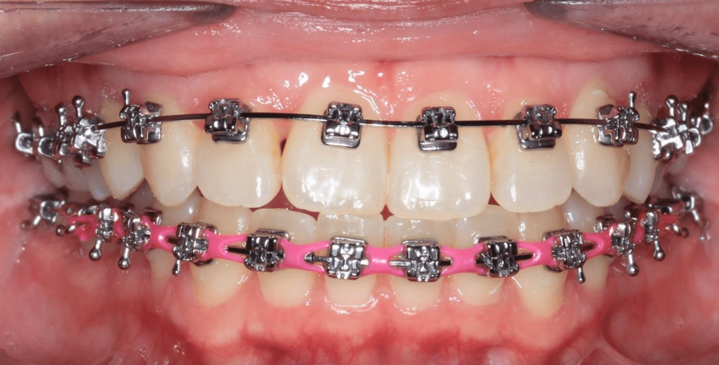 Adult Female Patient With Moderate Crowding And Protrusive Upper And Lower Teeth Adult Female Patient With Moderate Crowding And Protrusive Upper And Lower Teeth