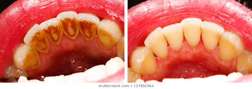 dental calculus before and after