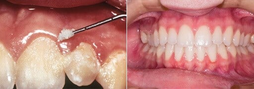 Plaque IV STANDALONE MULTI-IMPACTS