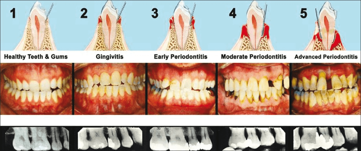 How To Use One Correctly Which Model To Buy And How It Compares To Flossing Waterpiks