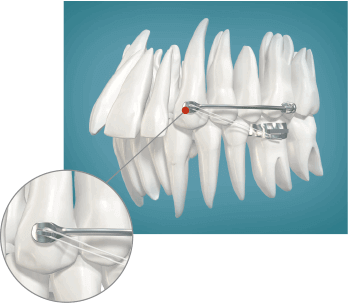 Carriere® Correction Appliance in Las Vegas, NV | The Art of Braces